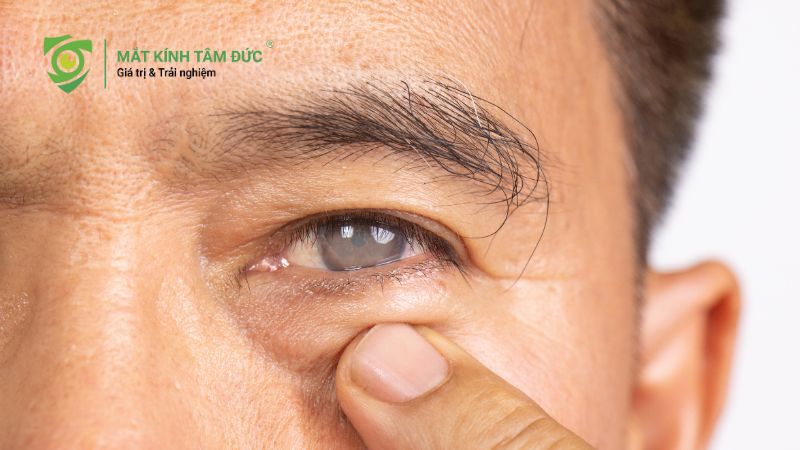 Mắt nhìn gần bị nhòe là bệnh gì? Cảnh báo các bệnh lý mắt thường gặp