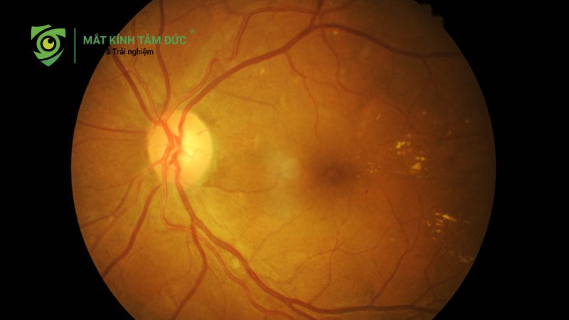 Mắt nhìn gần bị nhòe là bệnh gì? Cảnh báo các bệnh lý mắt thường gặp