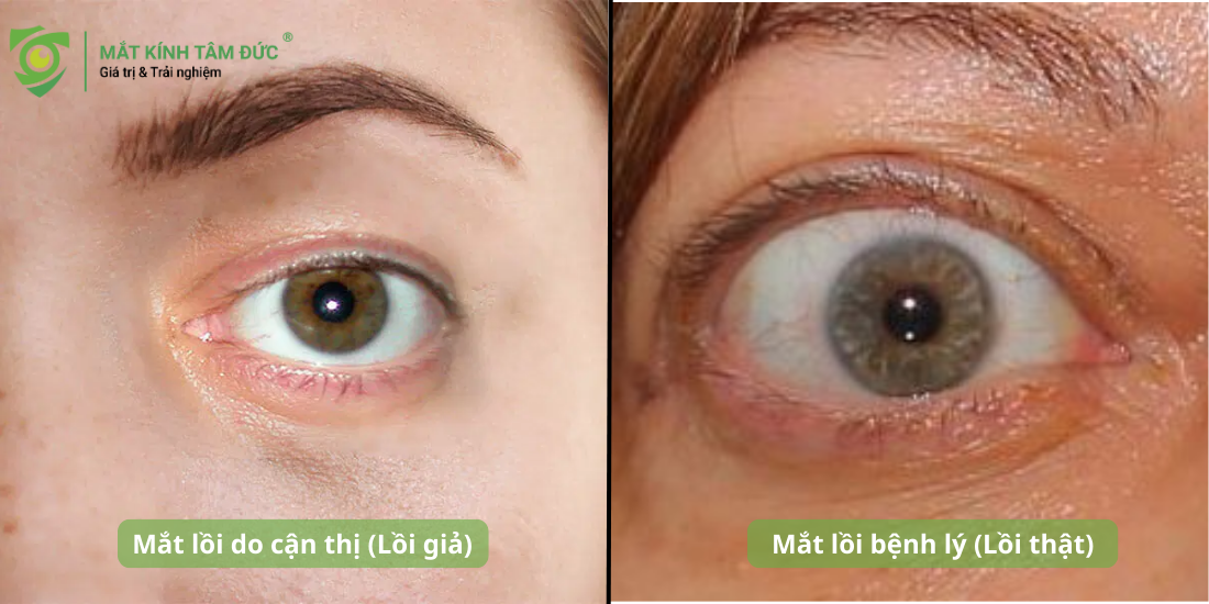 Cách phân biệt mắt lồi cận thị và mắt lồi bệnh lý