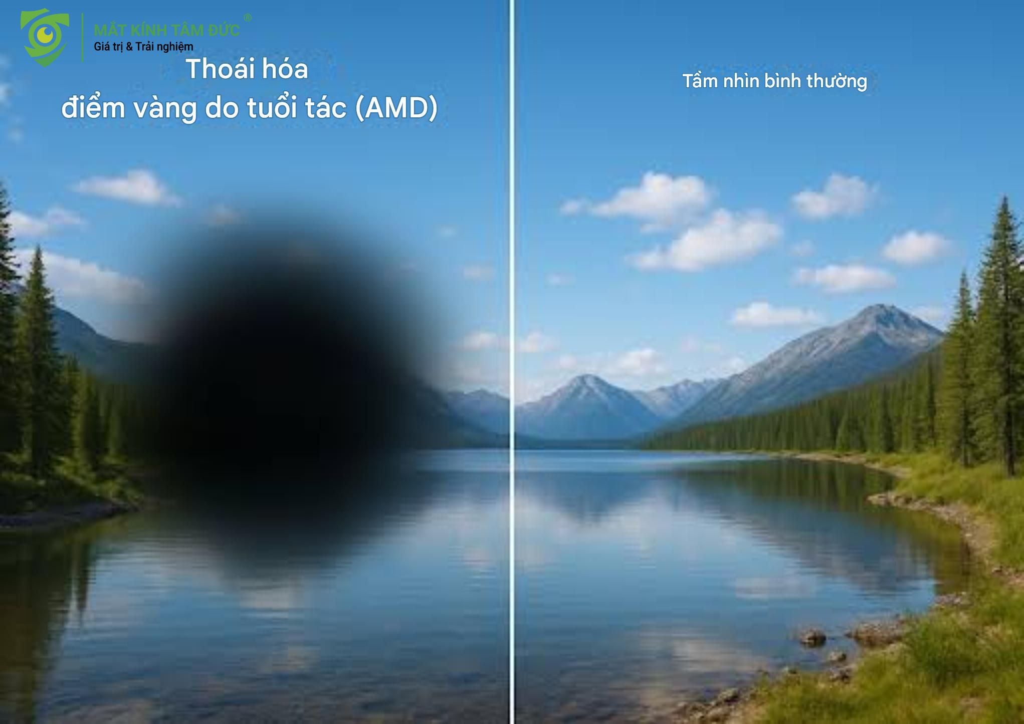 cảnh báo nguy hiểm khi bị lóa mắt thường xuyên là bị thoái hóa điểm vàng