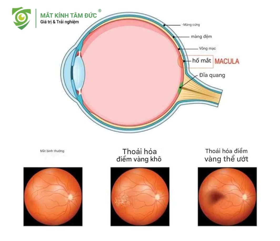 Thoái hóa điểm vàng do cận thị nặng.