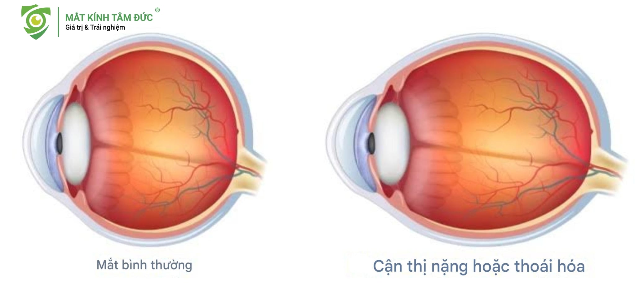 Cận nặng có bị mù không? điểm khác biệt cốt lõi nằm ở trục nhãn cầu