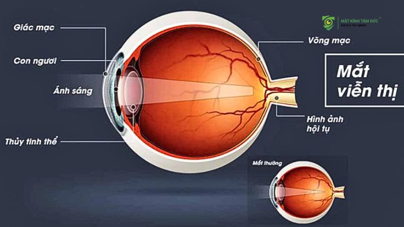 Viễn thị bao nhiêu độ là nặng? Dấu hiệu nhận biết và cách điều trị