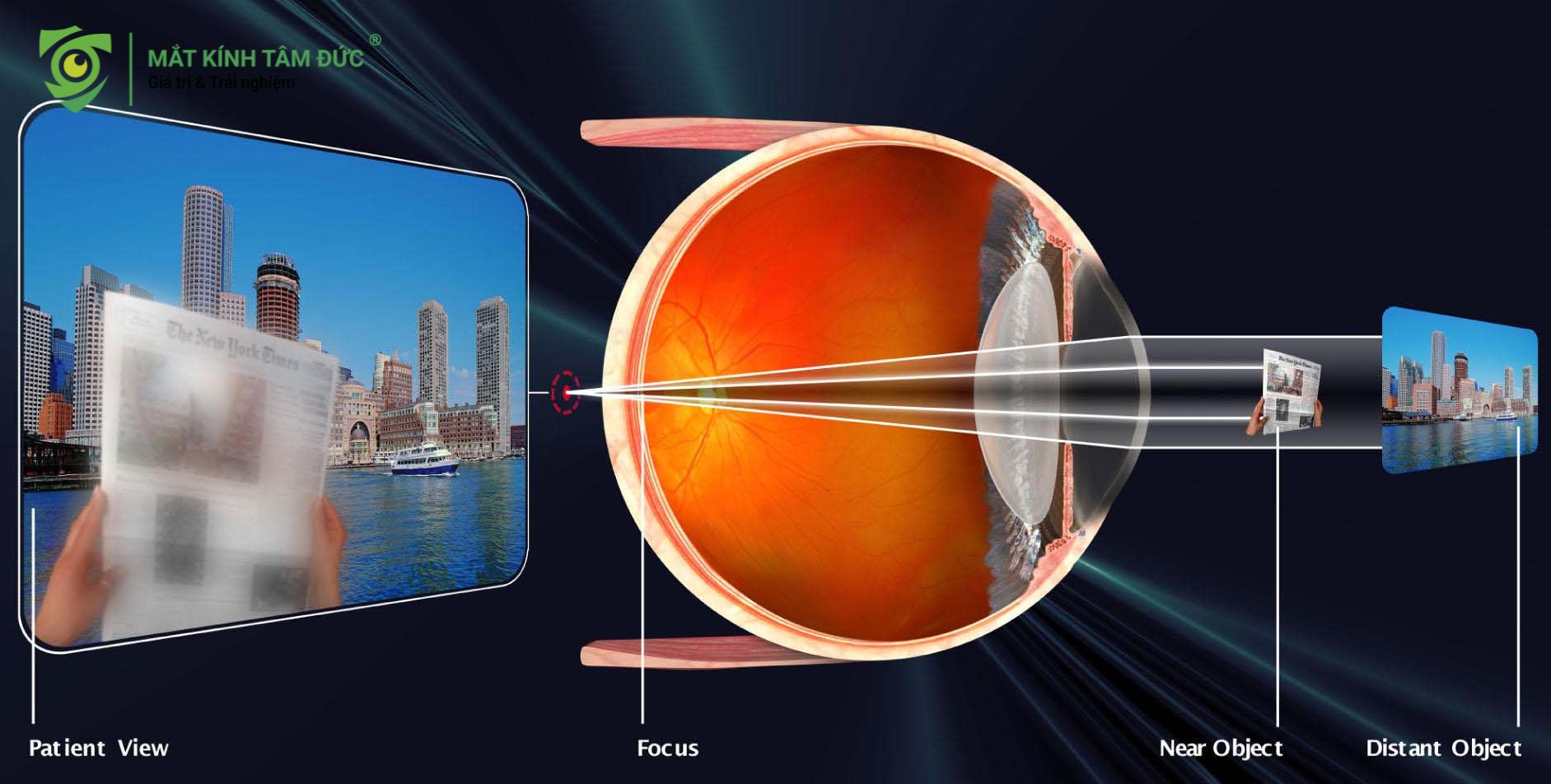 Viễn thị (Hyperopia) – "Nhìn xa rõ, nhìn gần mờ"