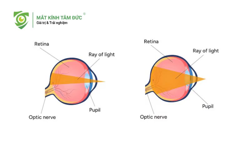 Đồng tử là gì? Vai trò và cách bảo vệ đồng tử khỏe mạnh