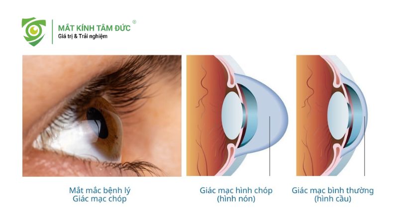 Giác mạc chóp là gì? 9 triệu chứng cảnh báo bạn không nên bỏ qua