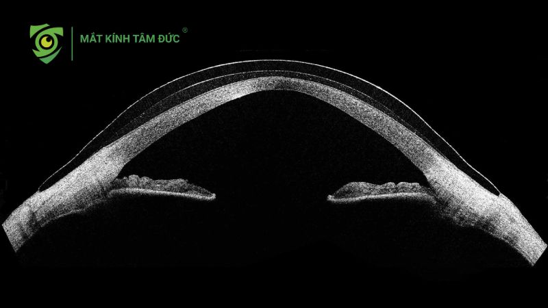 Giác mạc chóp là gì? 9 triệu chứng cảnh báo bạn không nên bỏ qua