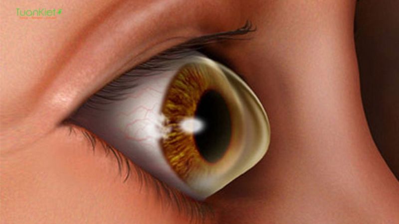 Giác mạc chóp là gì? 9 triệu chứng cảnh báo bạn không nên bỏ qua