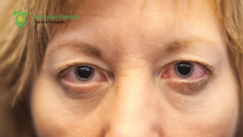 Giãn đồng tử là gì? Nguyên nhân và phương pháp xử lý hiệu quả