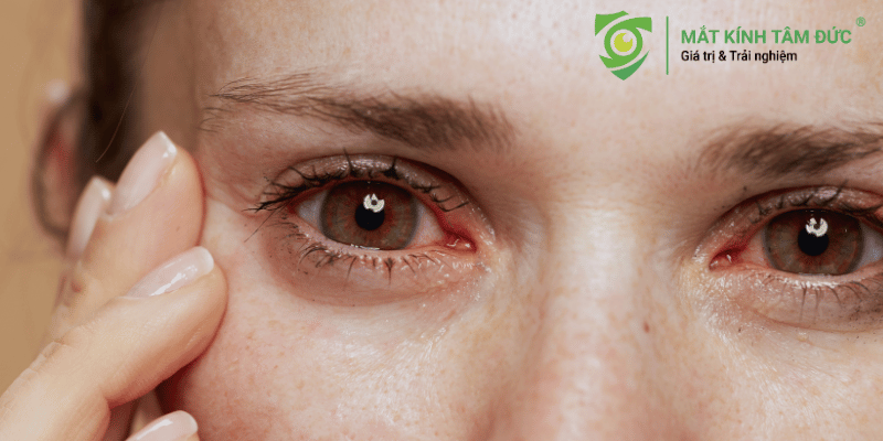 Mắt đỏ là gì và vì sao không nên xem nhẹ?