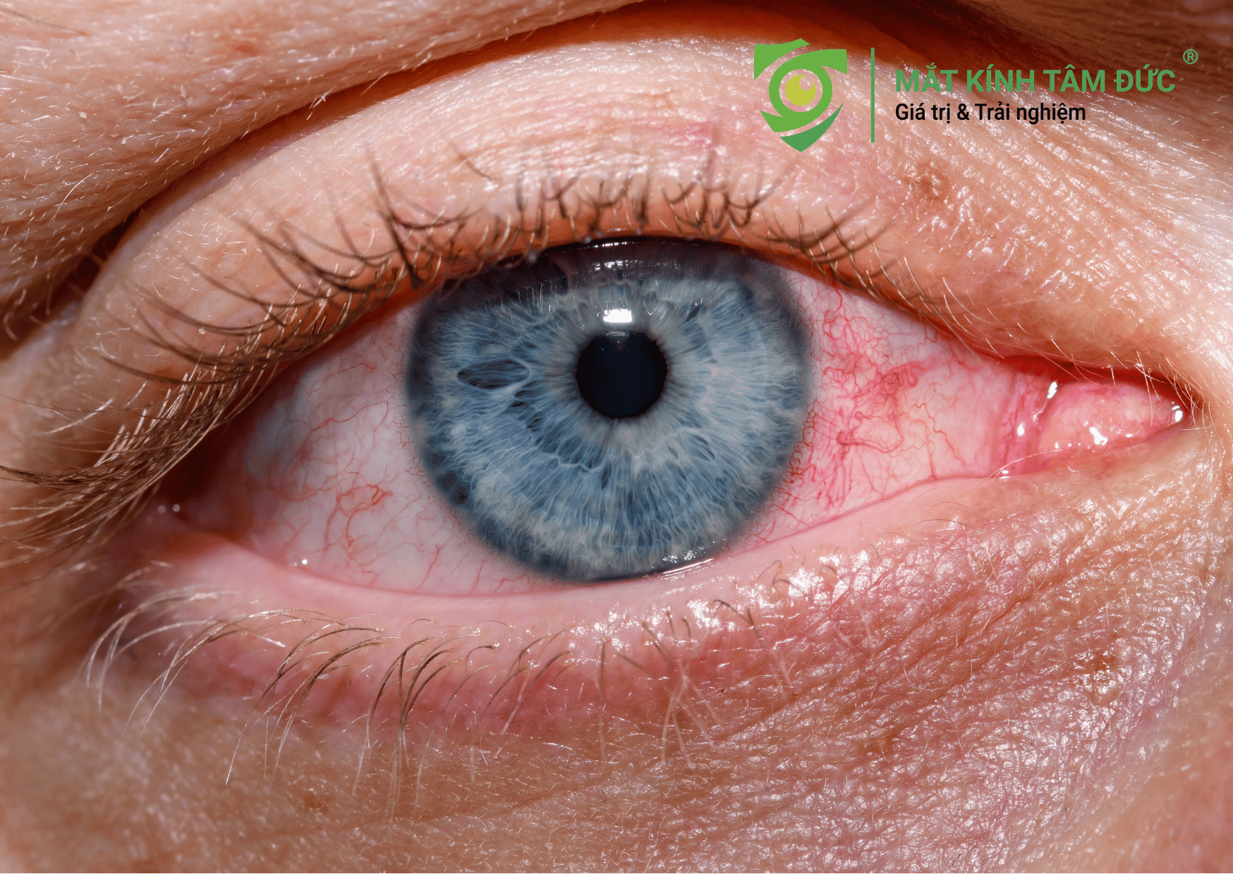 Đau mắt đỏ có lây khi nhìn nhau không?