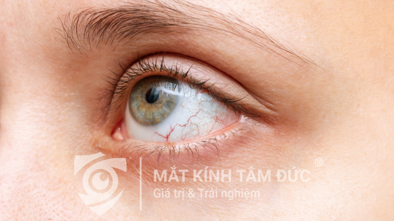 Mắt bị khô khi đeo lens thường xuyên