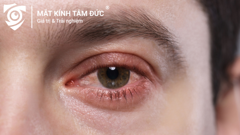 Đỏ mắt và khó chịu là rủi ro dễ gặp khi đeo lens sai cách