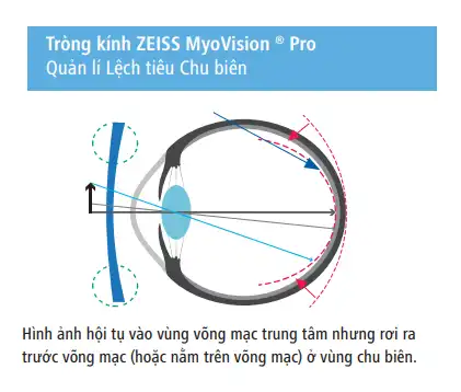 ZEISS MyoVision Pro hoạt động như thế nào?
