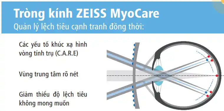 Công nghệ C.A.R.E trên ZEISS MyoCare/MyoCare S hoạt động như thế nào?