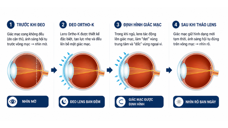 Minh họa cơ chế hoạt động của kính Ortho-K khi đeo ban đêm